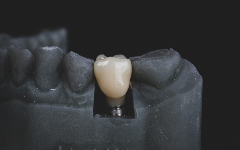 Dental implant crown on a jaw model