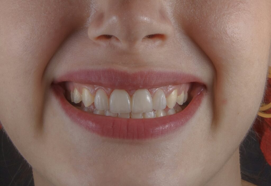 Natural-looking white smile
