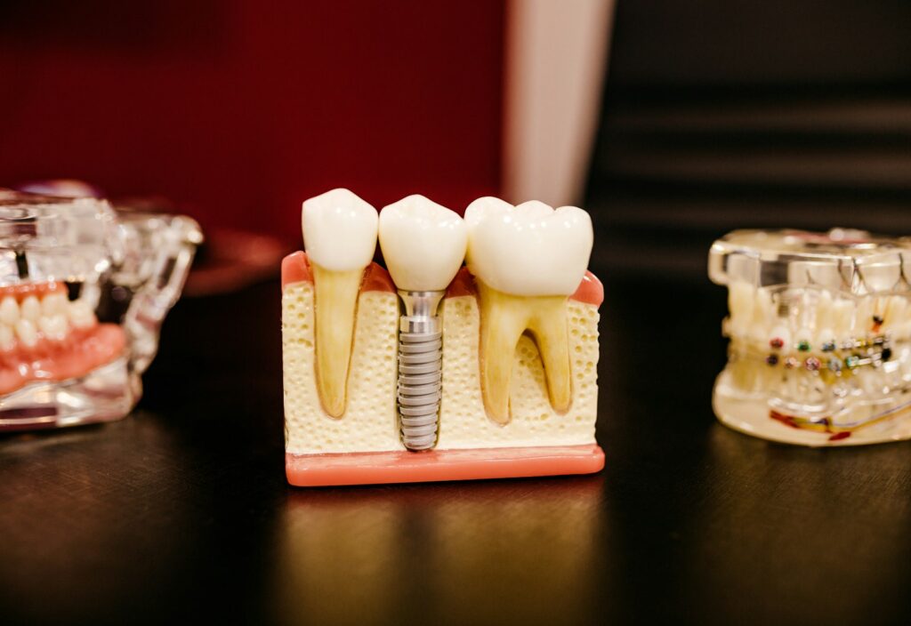 Implant-supported teeth model