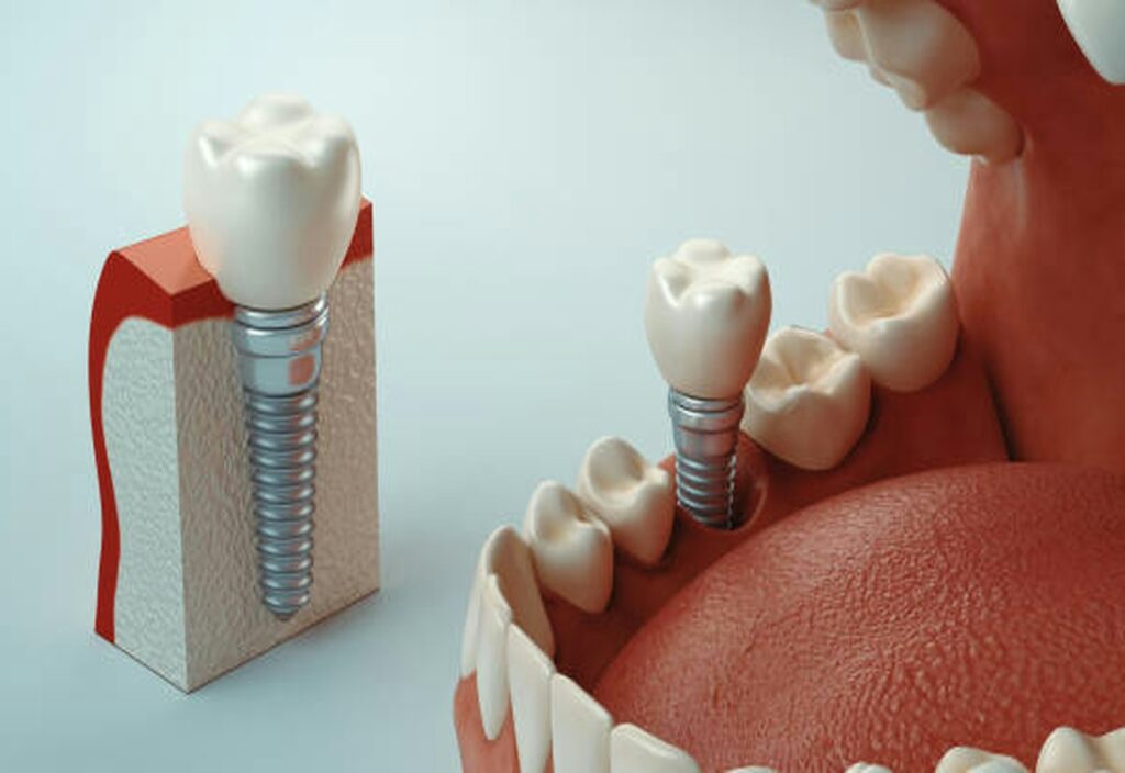 Model of a dental implant beside natural teeth