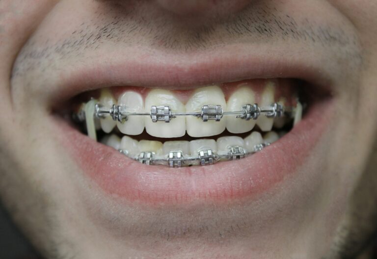 Smile with orthodontic braces