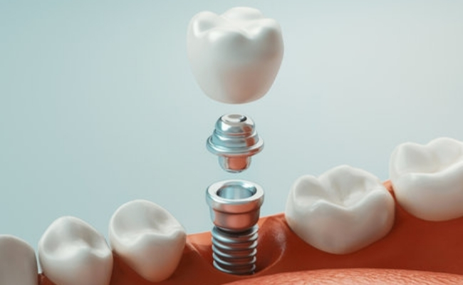 Dental-implants-32.jpg